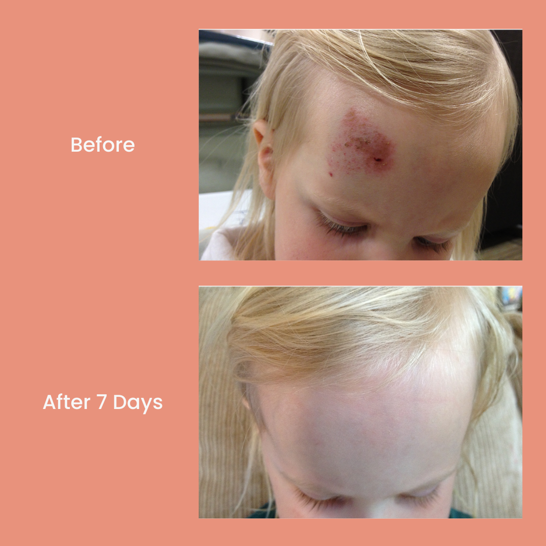 TrueLipids Boo-Boo & Bum Balm: Diaper Rash & Healing Cream for Babies