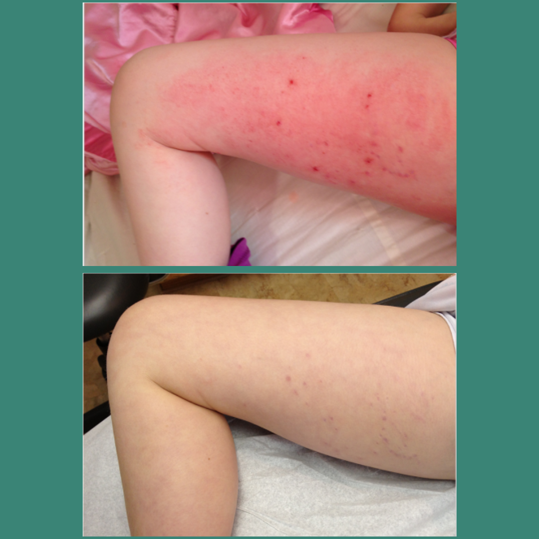 TrueLipids Ultimate Eczema Kit: Eczema Creams and Lotions for Skin Barrier Support