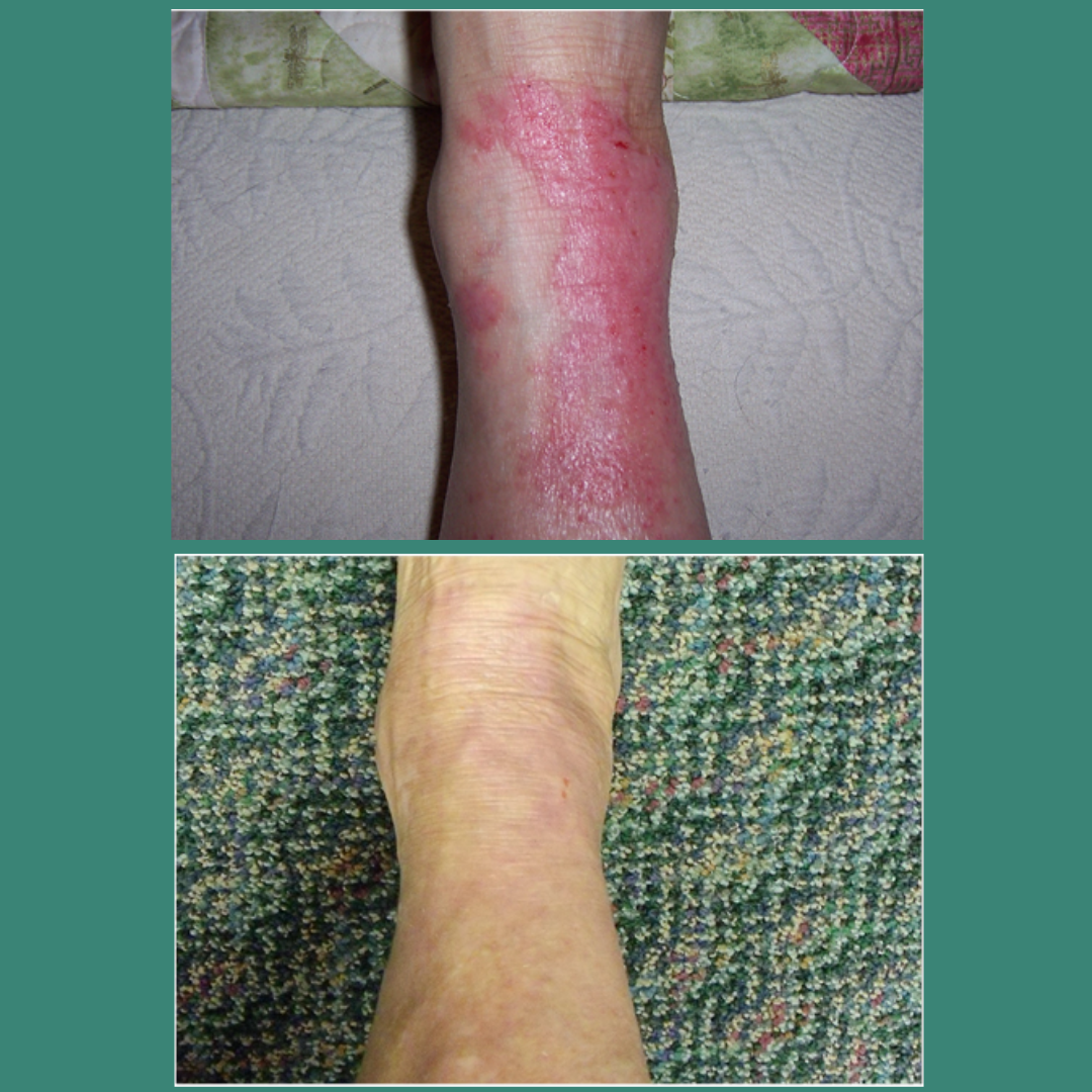 TrueLipids Ultimate Eczema Kit: Eczema Creams and Lotions for Skin Barrier Support