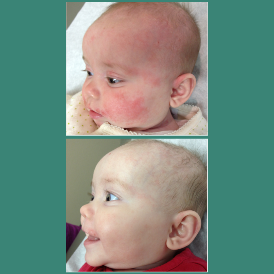 TrueLipids Ultimate Eczema Kit: Eczema Creams and Lotions for Skin Barrier Support