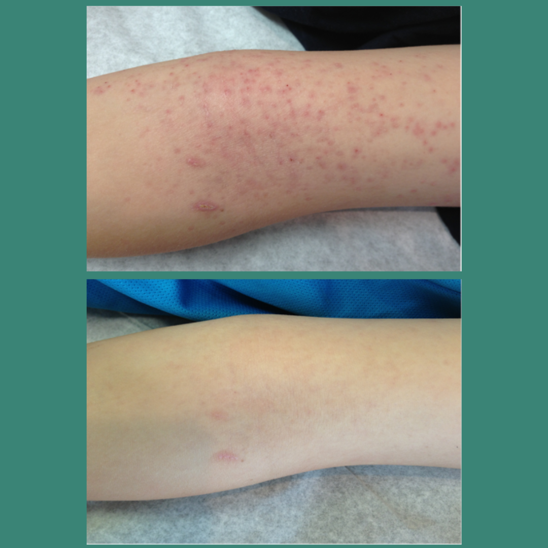 TrueLipids Ultimate Eczema Kit: Eczema Creams and Lotions for Skin Barrier Support