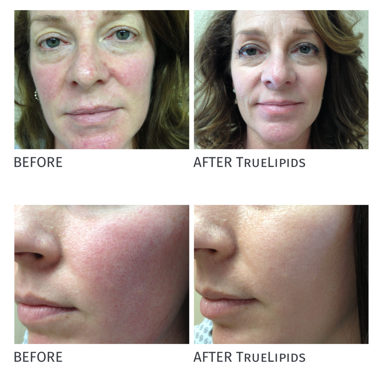 TrueLipids Redness Relief Kit: Anti Redness Creams for Sensitive Skin