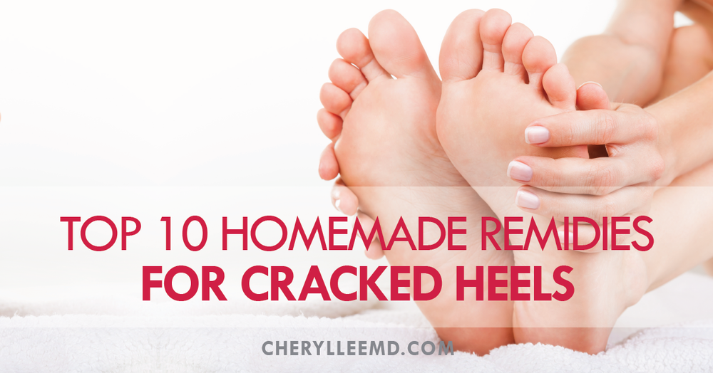 Tips to Remedy Cracked Heels