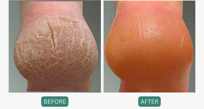 Dry Feet &amp; Hands Kit: Moisturizers for Dry Hands &amp; Cracked Feet