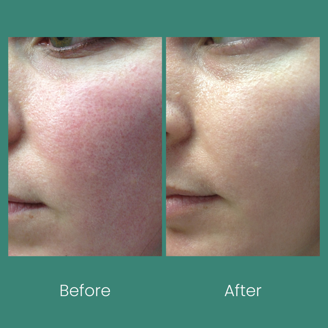 Redness Relief Kit: Anti Redness Creams for Sensitive Skin