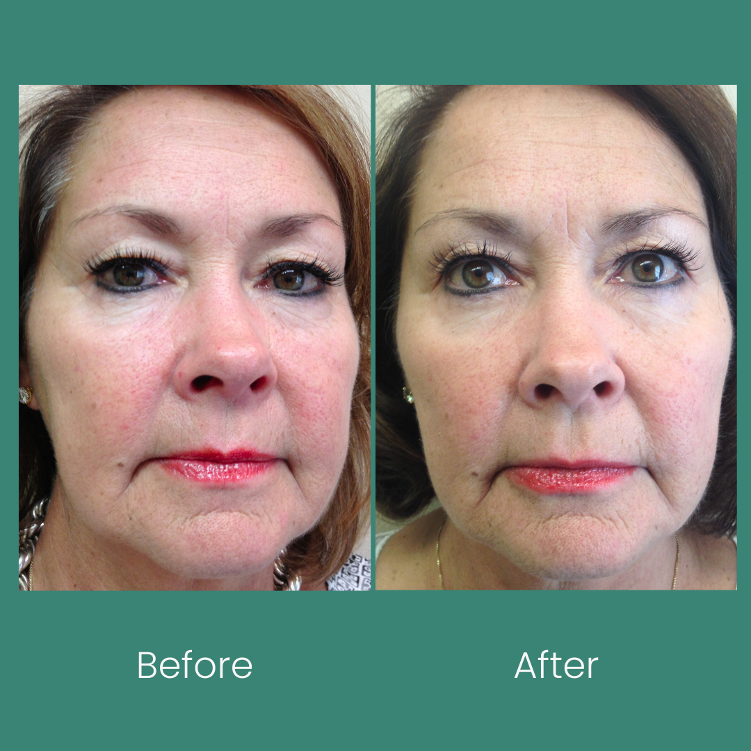 Redness Relief Kit: Anti Redness Creams for Sensitive Skin