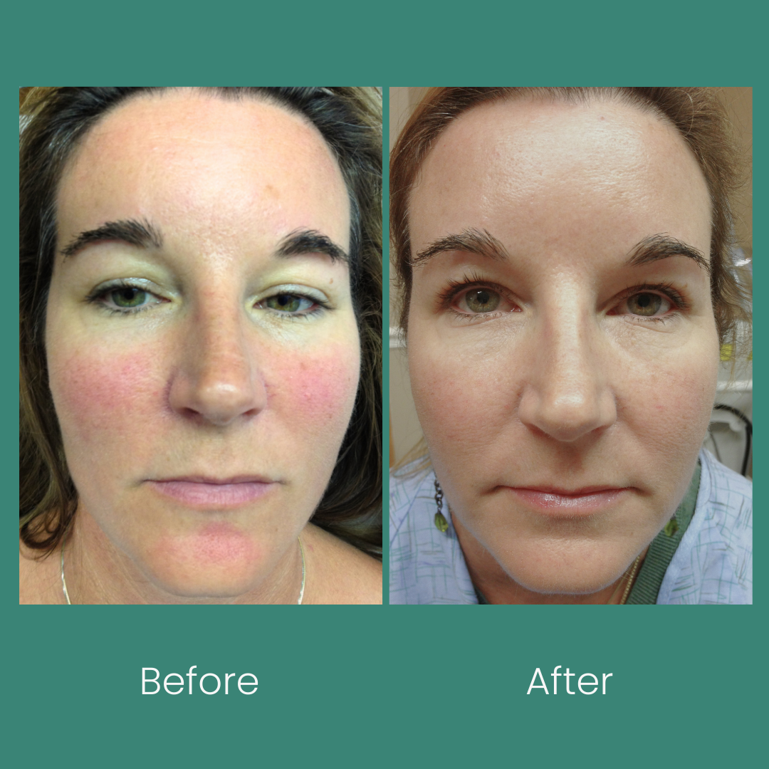 Redness Relief Kit: Anti Redness Creams for Sensitive Skin