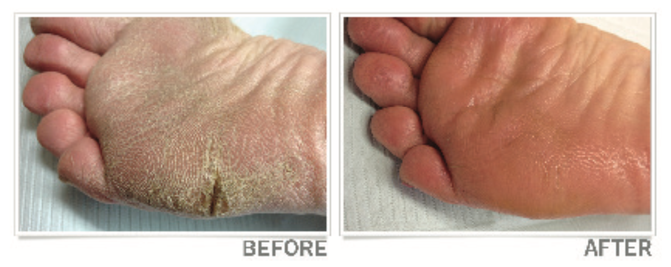 Cracked Hands Feet Treatment for Sensitive Skin CLMD Skin Care