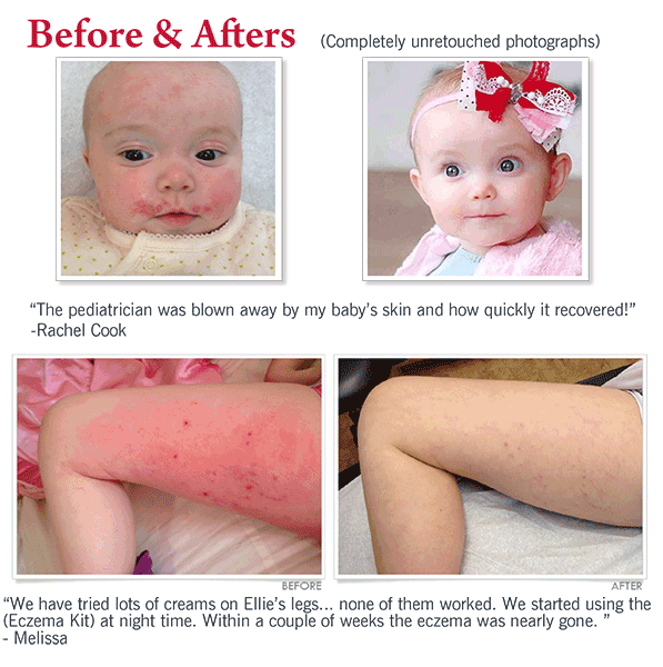 Eczema Experts Hydrocortisone Barrier Cream