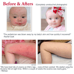 Eczema Experts Hydrocortisone Barrier Cream